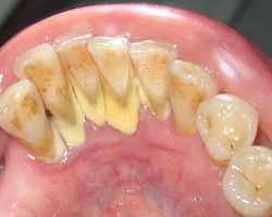 Zähne mit Zahnstein