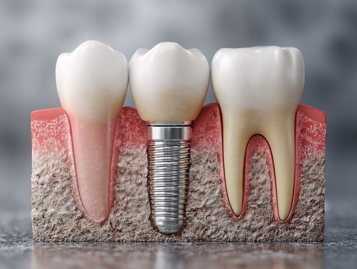Implantate als Lückenschluss